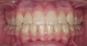 class3 Malocclusion_after