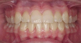 class3 Malocclusion_after class3 Malocclusion_after