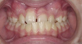 class3 Malocclusion_before