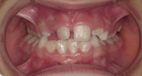 Post/Anterior Crossbite_Before